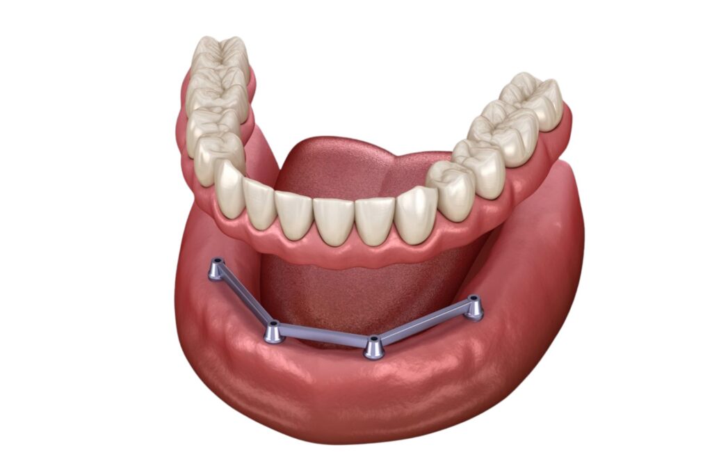 Stegprothese auf 4 Implantaten