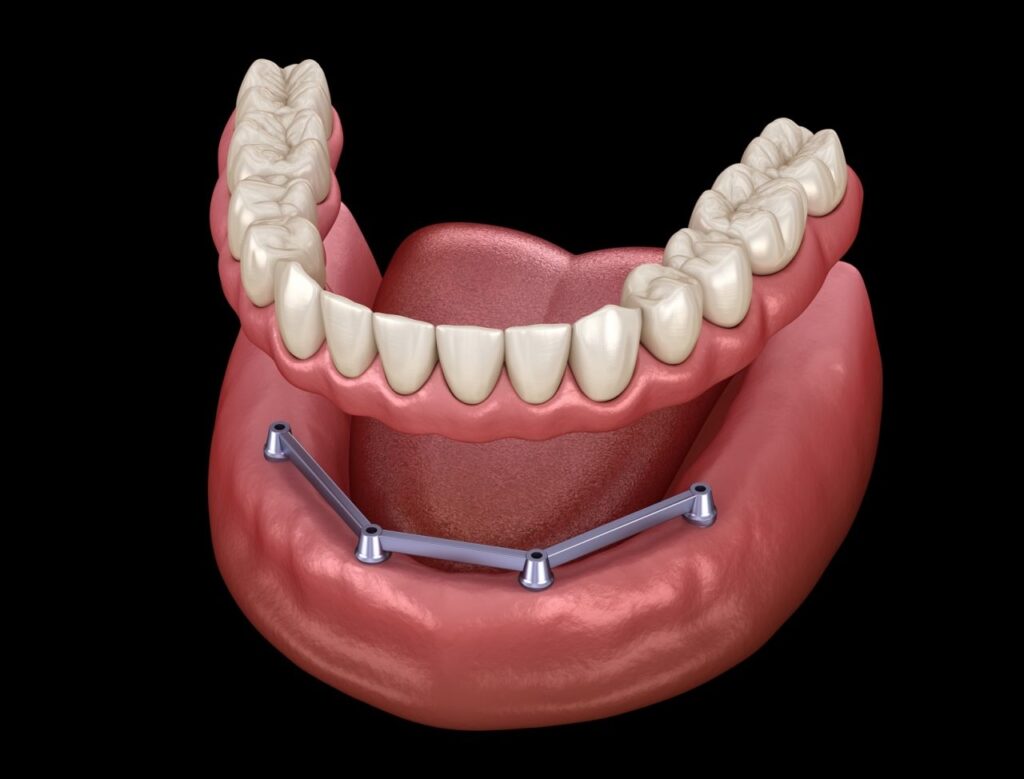 Stegprothese