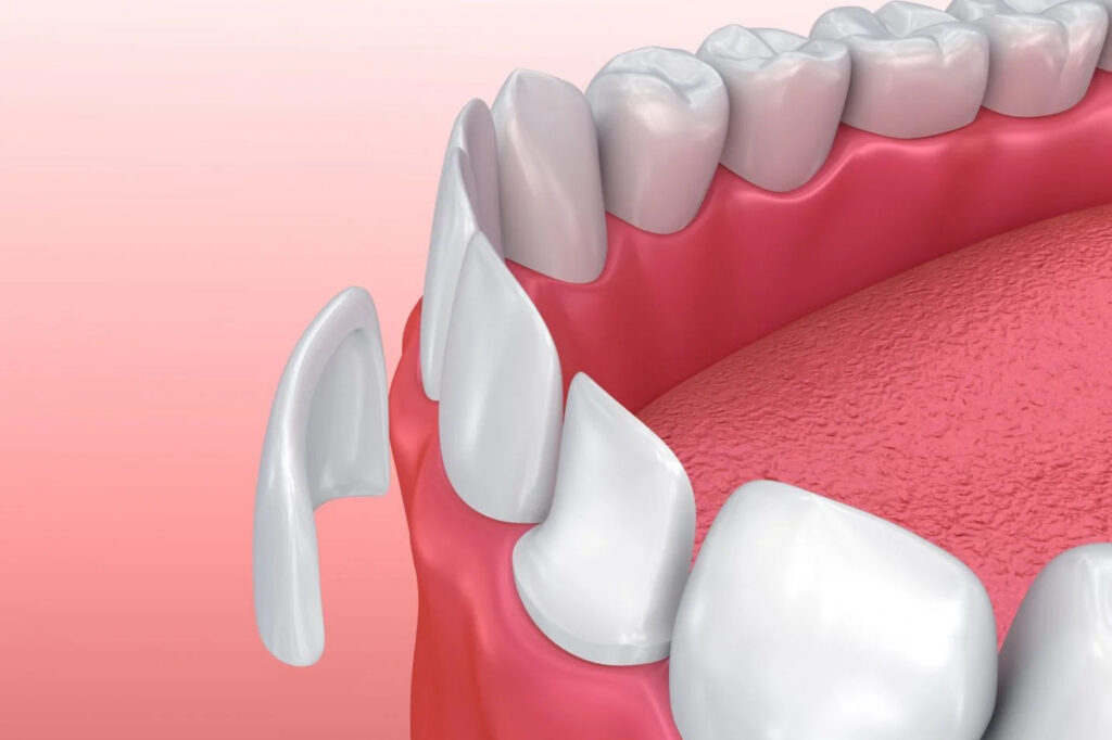 Veneers