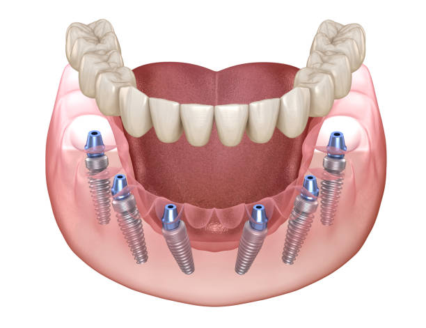 All-on-6 Prothese