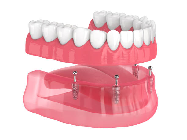 Locator-Prothese auf 4 Implantaten