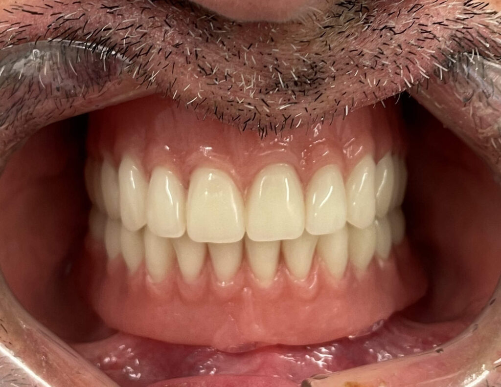 Locator-Prothese auf 4 Implantaten